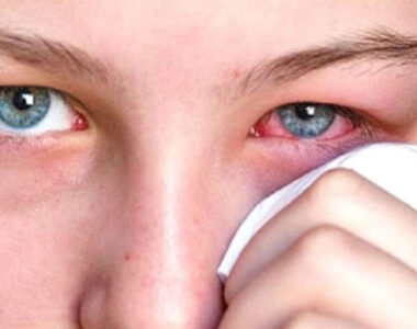 โรคตาแดง