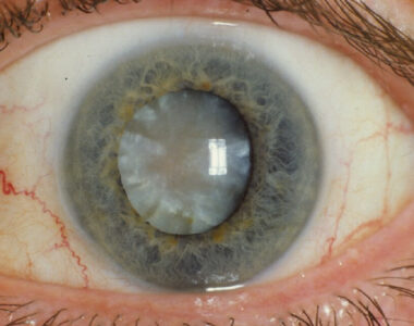 ต้อกระจก