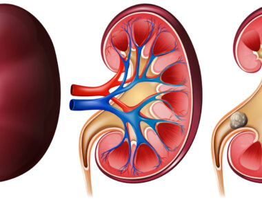 นิ่วในไต