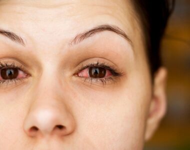 ภูมิแพ้ขึ้นตา