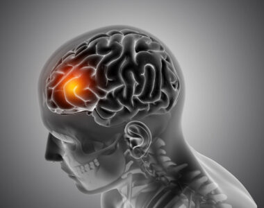 เนื้องอกในสมอง