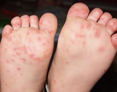 มือ เท้า ปาก