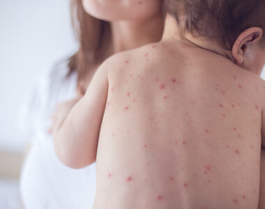 หัดเยอรมัน